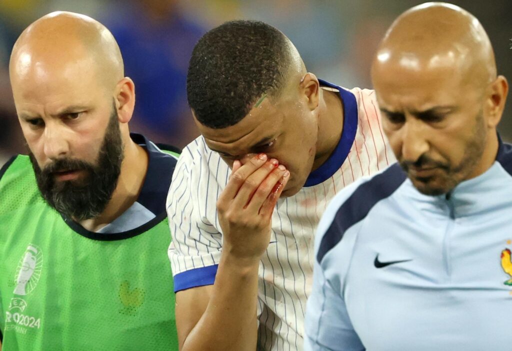 Mbappé no será operado de la nariz