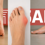 Fascitis plantar juanetes y pie plano: causas comunes